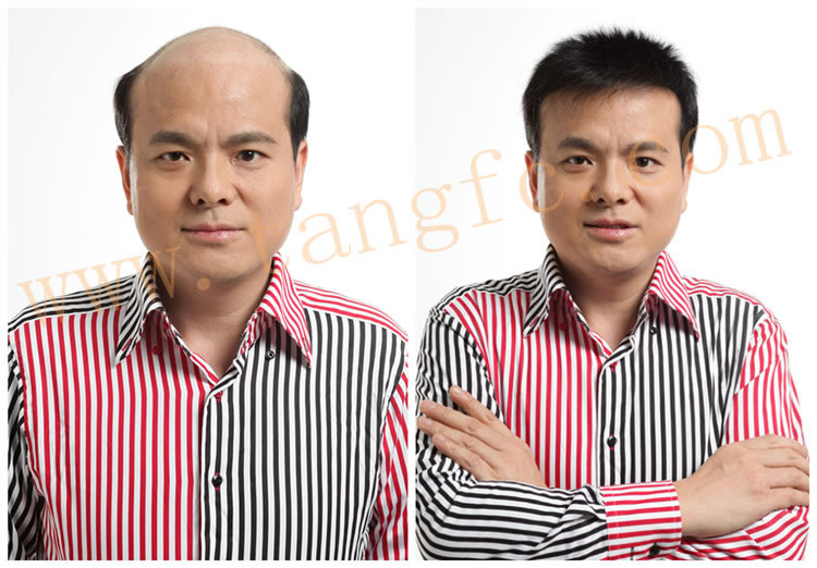 男性脫發(fā)是否真的無可奈何 男性脫發(fā)是否真的無可奈何