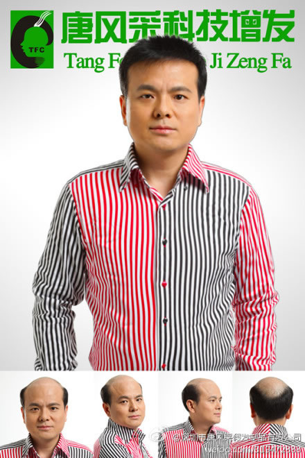 脫發(fā)能致癌是真的么？