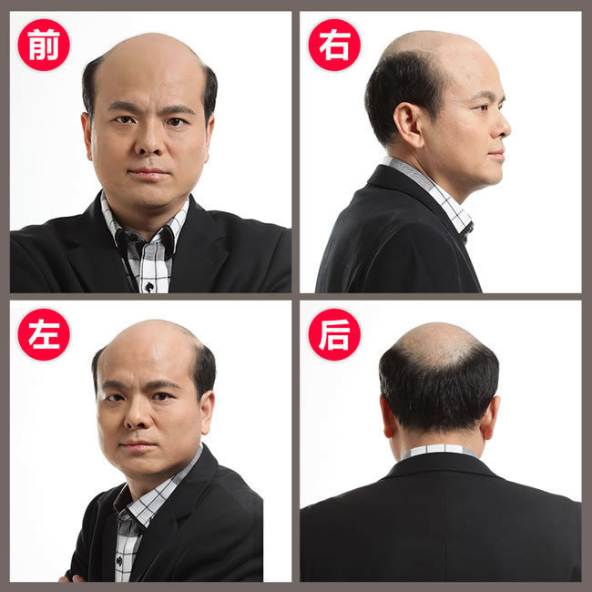 前額兩邊頭發(fā)稀疏怎么辦？看了你就知道怎么解決！