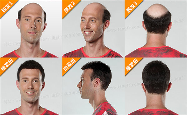 禿頂補(bǔ)發(fā)就選唐風(fēng)采補(bǔ)發(fā)機(jī)構(gòu) 禿頂怎么辦 禿頂補(bǔ)發(fā)就選唐風(fēng)采補(bǔ)發(fā)機(jī)構(gòu)