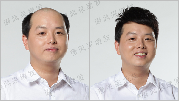 遺傳謝頂怎么辦？唐風(fēng)采健康物理增發(fā)來幫你！