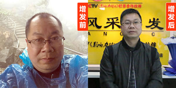 頭發(fā)再生的方法有哪些？看了你就知道了！