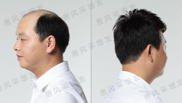 禿頂適合什么發(fā)型？怎么樣才能讓發(fā)型適合自己