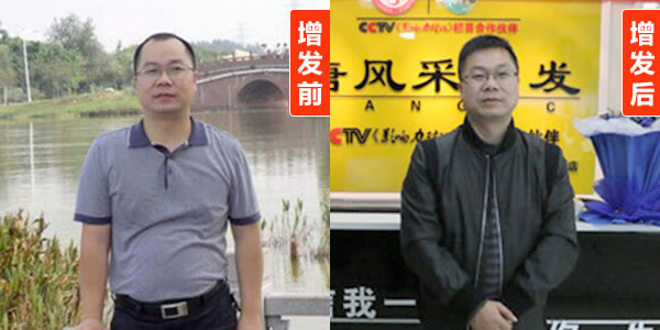 臨沂哪里有仿真假發(fā)嗎？針對(duì)禿頭的那種相關(guān)推薦