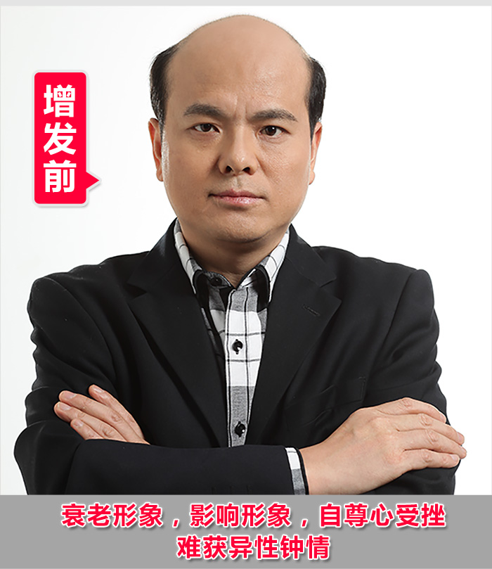 掉頭發(fā)很厲害怎么辦？2016新解決掉發(fā)的方法