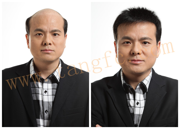 廈門頭發(fā)稀少如何解決？人為什么會脫發(fā)