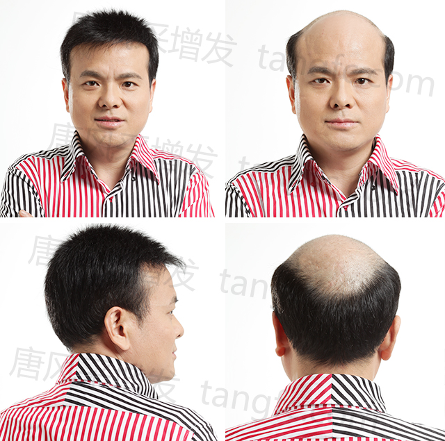 脫發(fā)禿頂?shù)目诵恰鹕剿饺硕ㄖ聘叨思侔l(fā)！