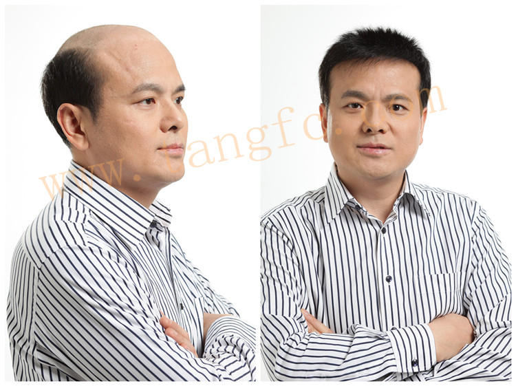 藥物、植發(fā)和增發(fā)，正在脫發(fā)的你選擇哪個好呢？