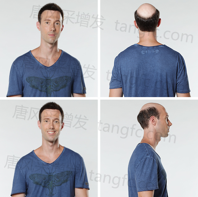 發(fā)際線高的同學(xué)，在同齡人中立馬看出年齡差距&nbsp;