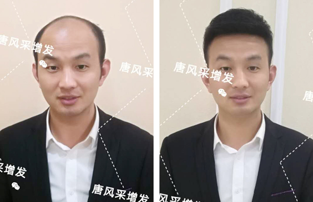 輸了頭發(fā)不能輸氣質(zhì)，看帥哥的逆襲之路！