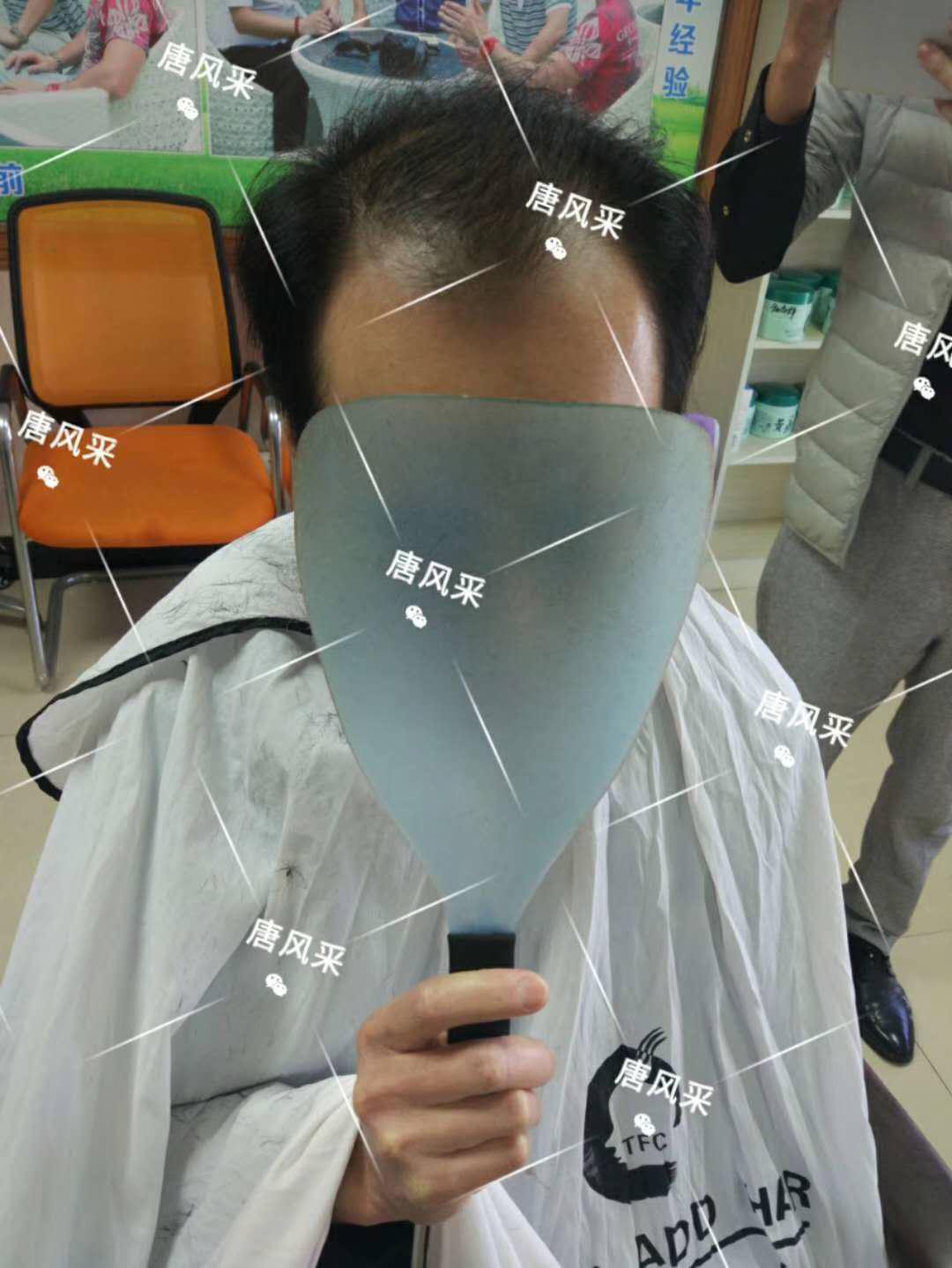 脫發(fā)謝頂壓力大，增發(fā)補發(fā)一身輕！