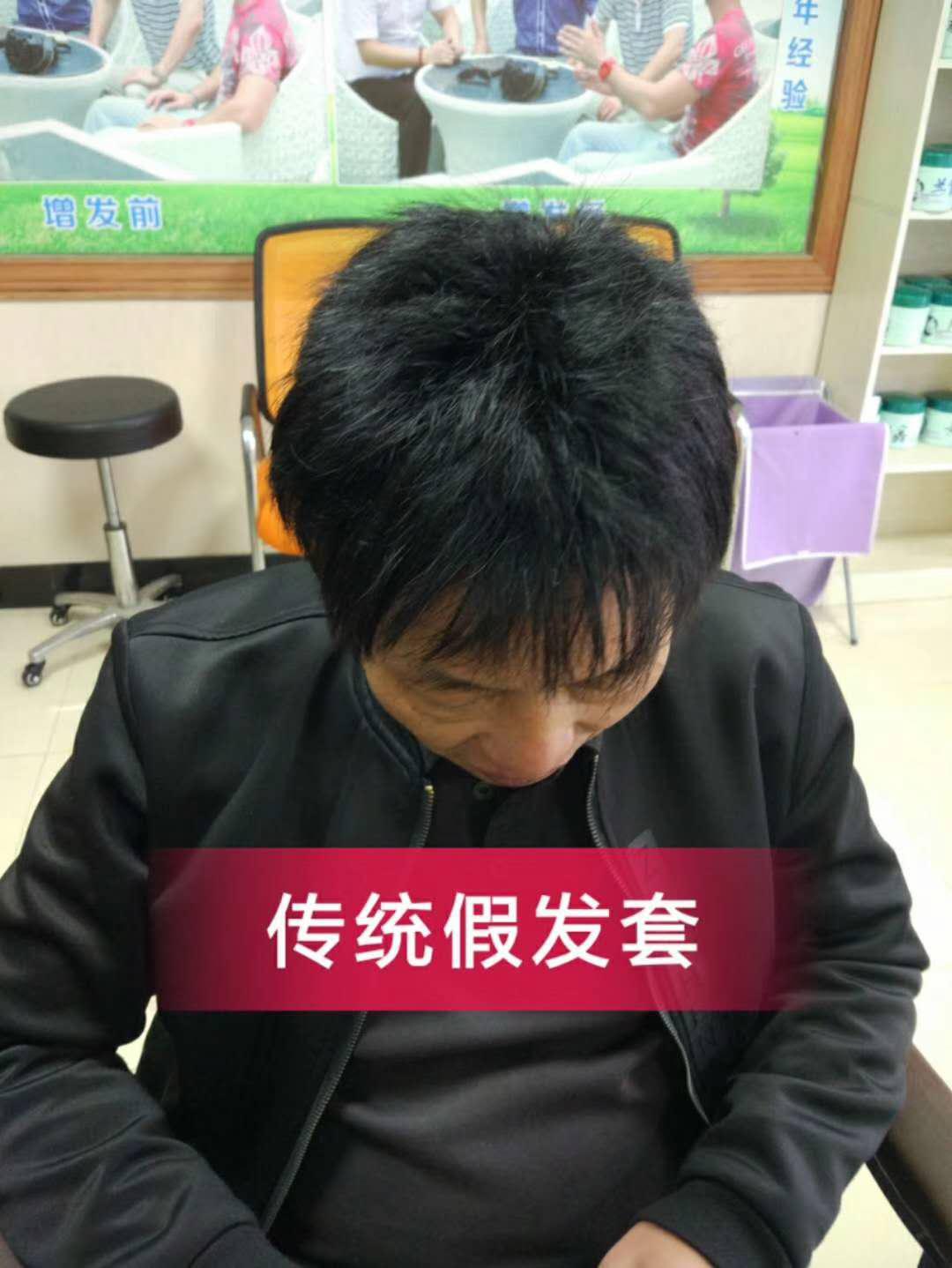 脫發(fā)謝頂壓力大，增發(fā)補發(fā)一身輕！