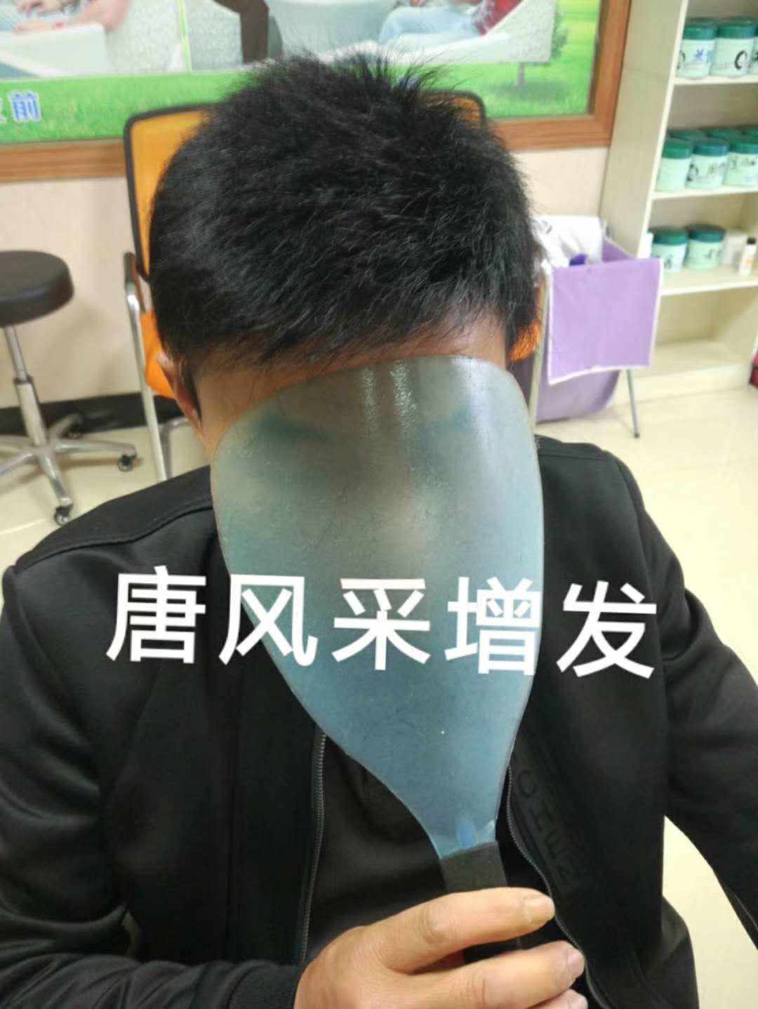 脫發(fā)謝頂壓力大，增發(fā)補發(fā)一身輕！