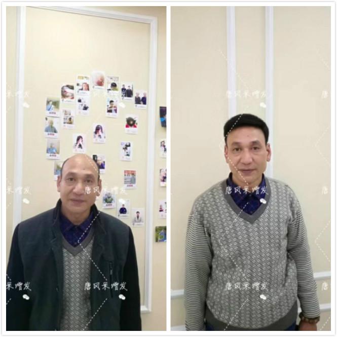 頭發(fā)少怎么辦？