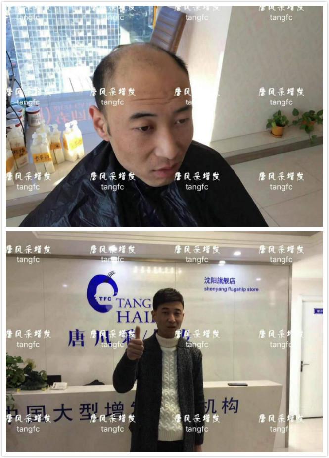 為脫發(fā)者解千愁，增發(fā)前后的驚人對比！