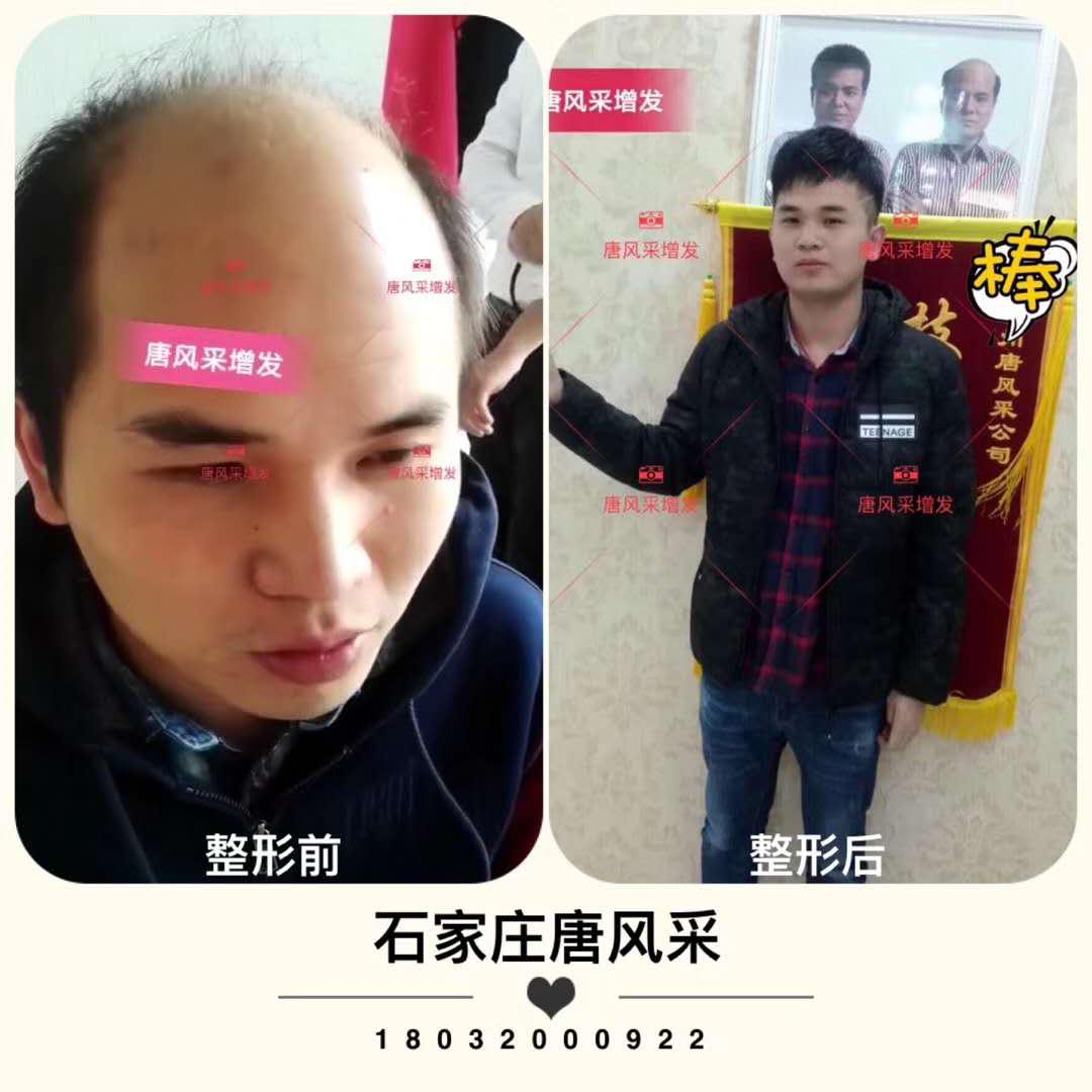 頭發(fā)少怎么辦？