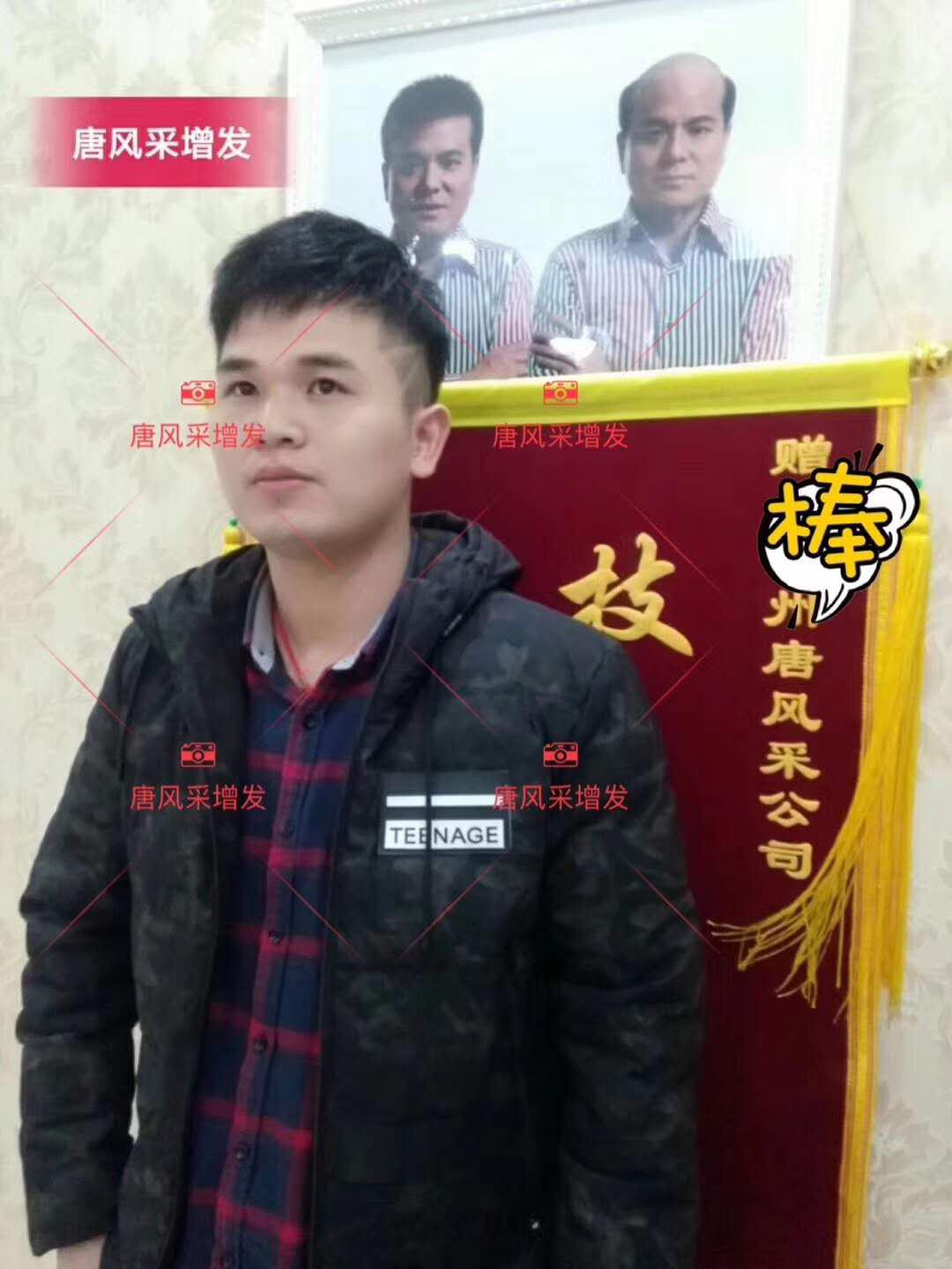 為脫發(fā)者解千愁，增發(fā)前后的驚人對比！