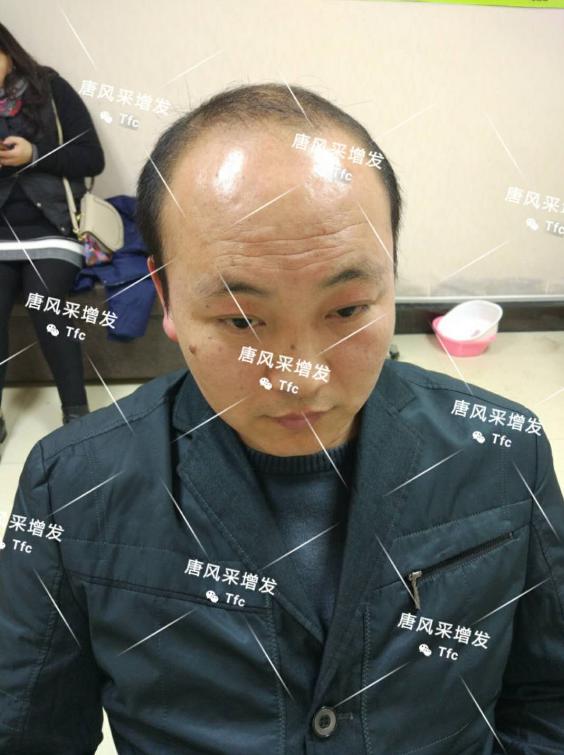 人民公仆也脫發(fā)，廈門夏先生增發(fā)記