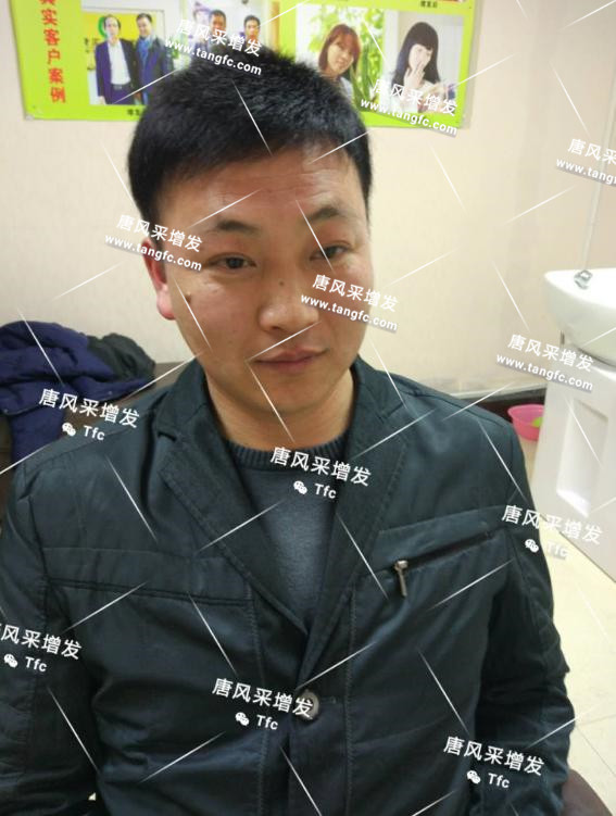 人民公仆也脫發(fā)，廈門夏先生增發(fā)記