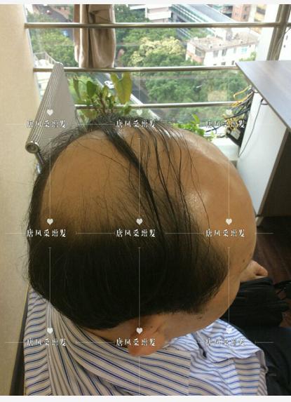 存款重要還是頭發(fā)重要？聽聽李先生怎么說！