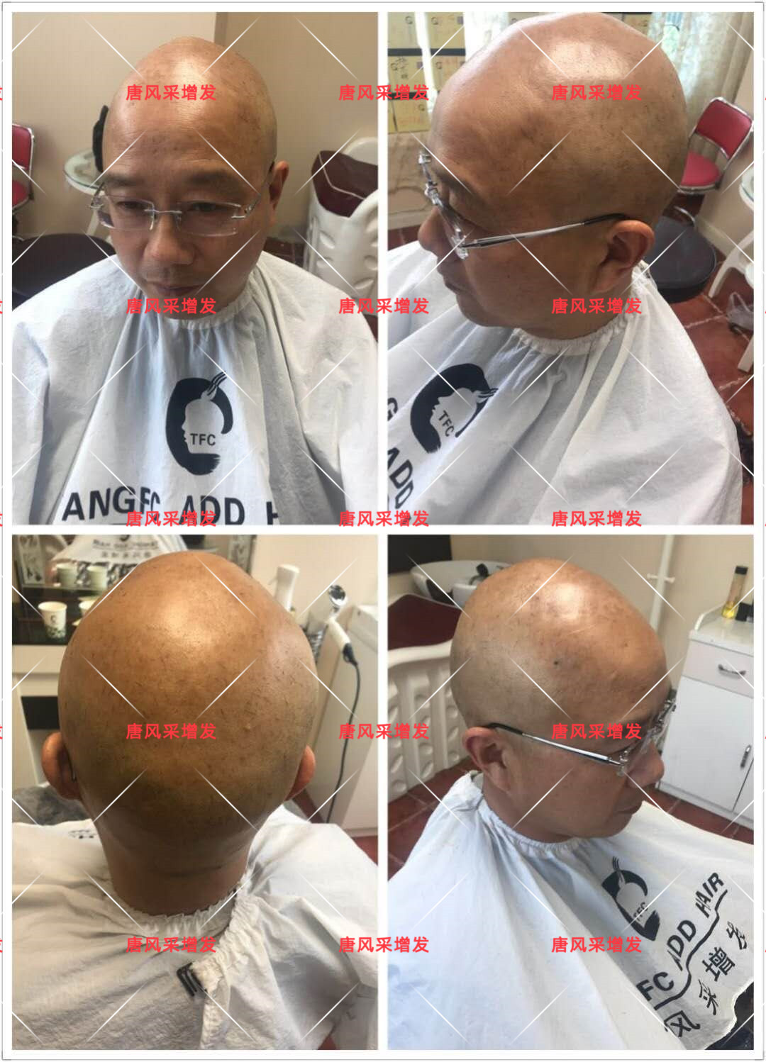 10年脫發(fā)困擾，一次性解決，唐風(fēng)采助力查先生“夢(mèng)想成真”