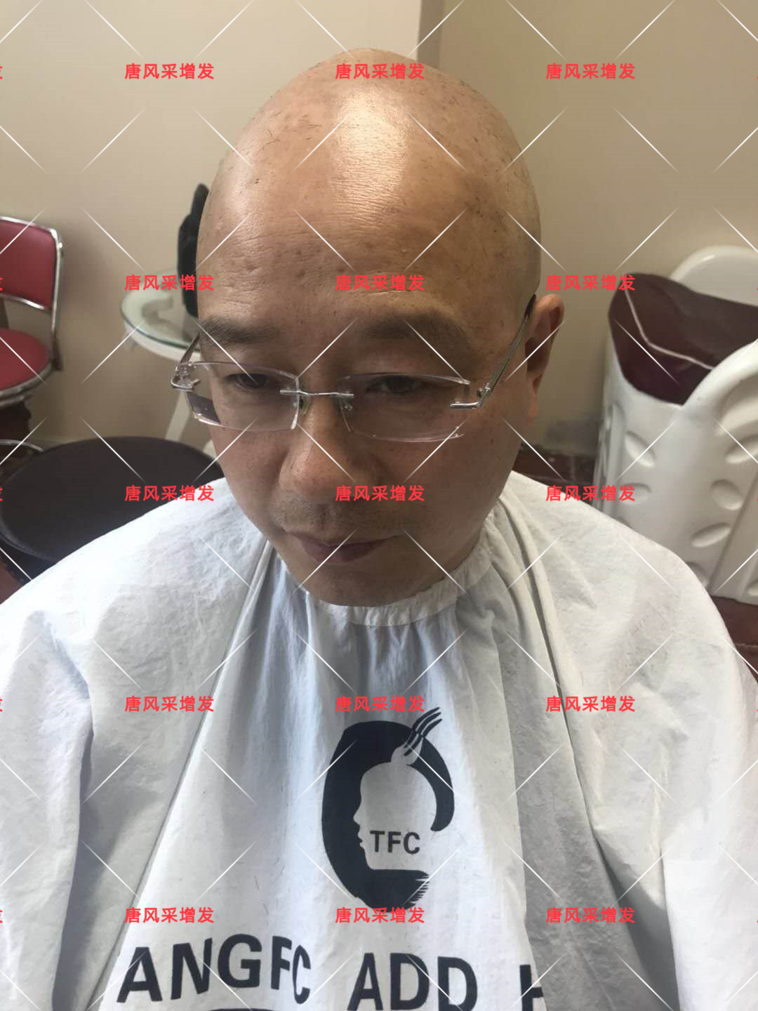 10年脫發(fā)困擾，一次性解決，唐風(fēng)采助力查先生“夢(mèng)想成真”