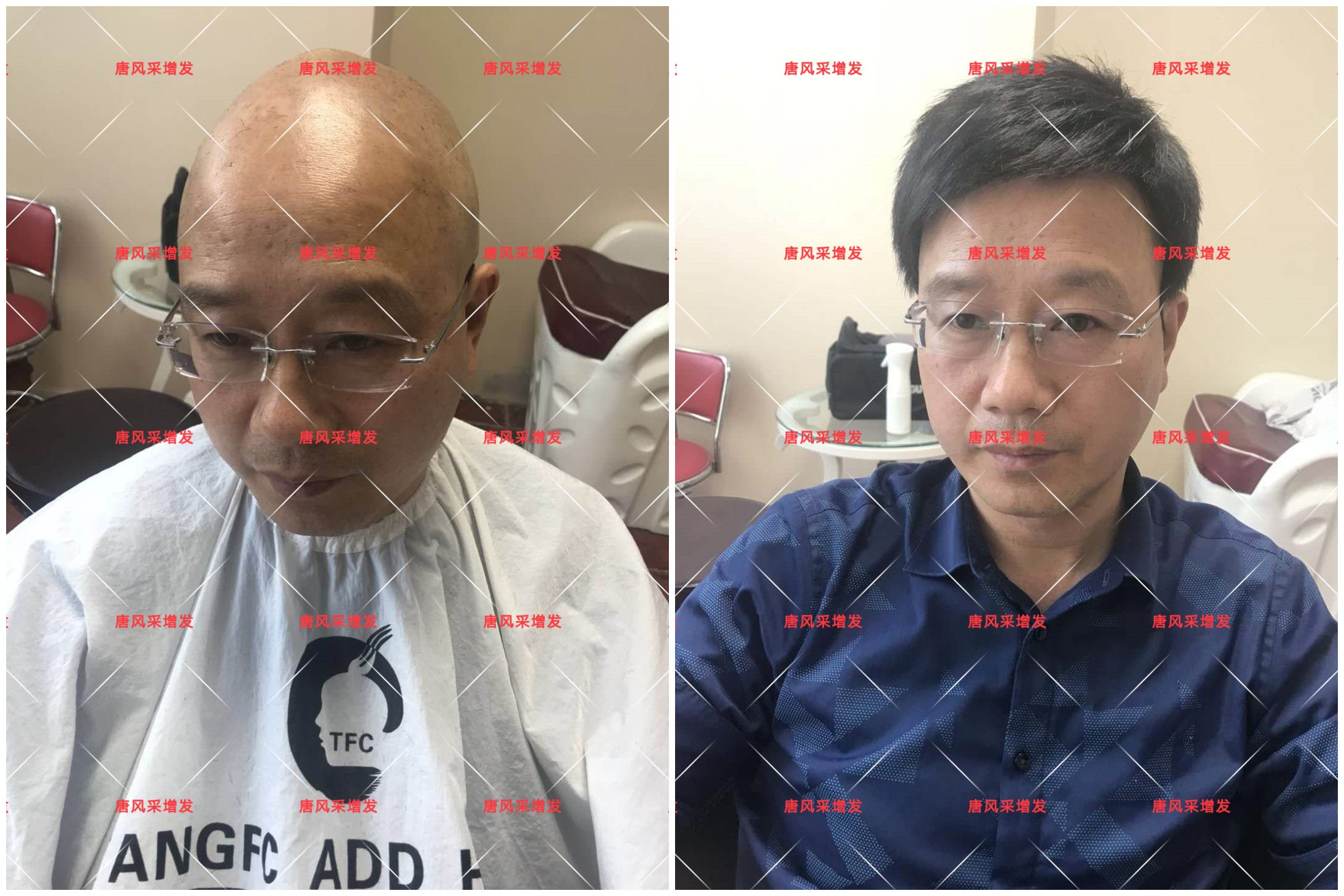 10年脫發(fā)困擾，一次性解決，唐風(fēng)采助力查先生“夢(mèng)想成真”