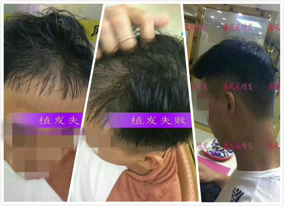 開始脫發(fā)的朋友上醫(yī)院，見到專家后他徹底絕望了！