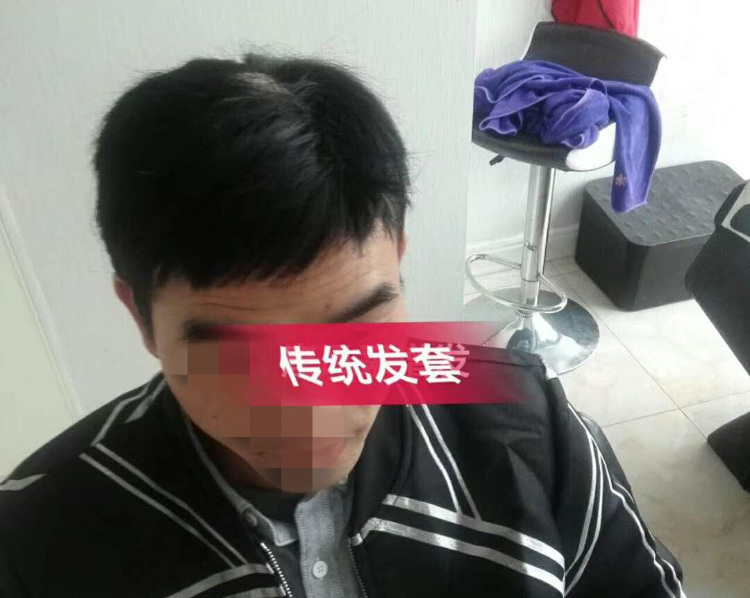開始脫發(fā)的朋友上醫(yī)院，見到專家后他徹底絕望了！