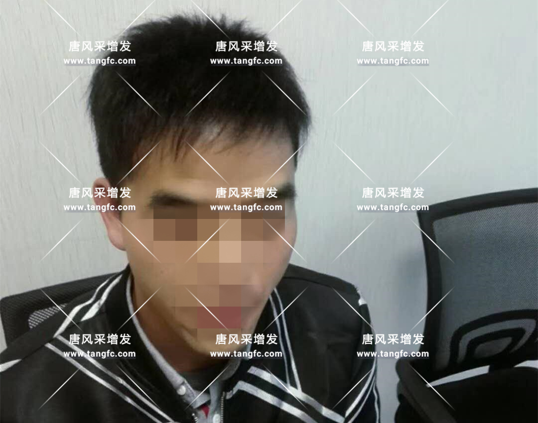 開始脫發(fā)的朋友上醫(yī)院，見到專家后他徹底絕望了！