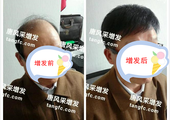 開始脫發(fā)的朋友上醫(yī)院，見到專家后他徹底絕望了！