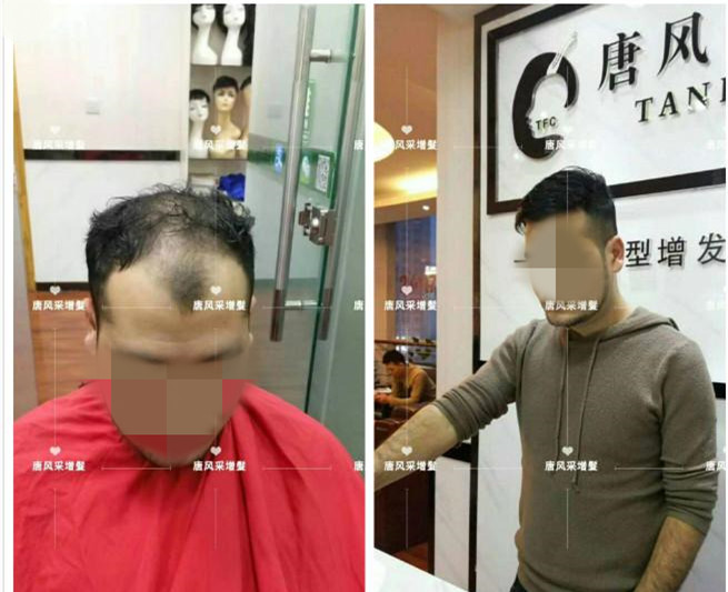 謝頂是顏值也拯救不了的尷尬！