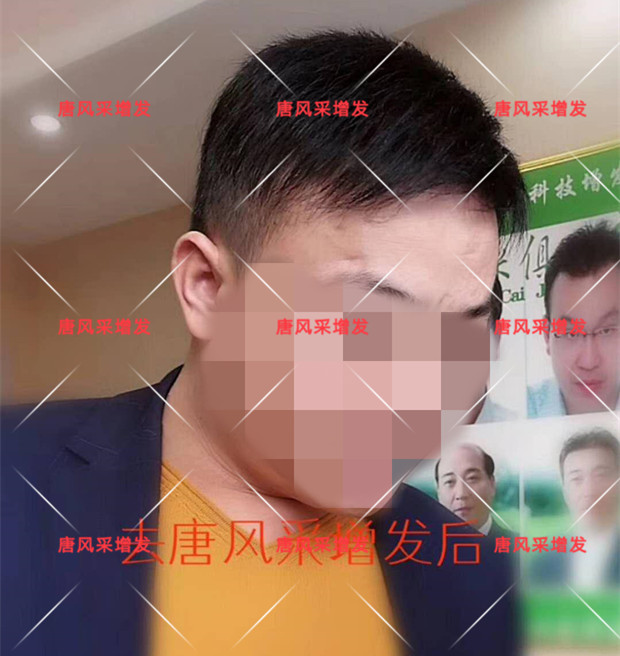 謝頂是顏值也拯救不了的尷尬！