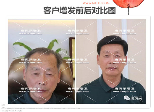 雙節(jié)同慶，給脫發(fā)的父親什么禮物，讓父親“年輕10歲”的神