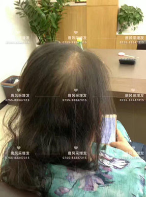 頭發(fā)稀少了，我該拿什么來拯救你？