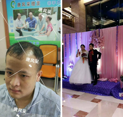 我還沒(méi)有脫單，怎么就脫發(fā)了呢?