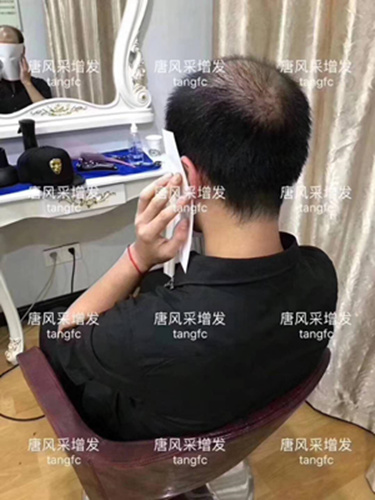 西寧補發(fā)哪里好誰知道？ 90后脫發(fā)了想做補發(fā)！