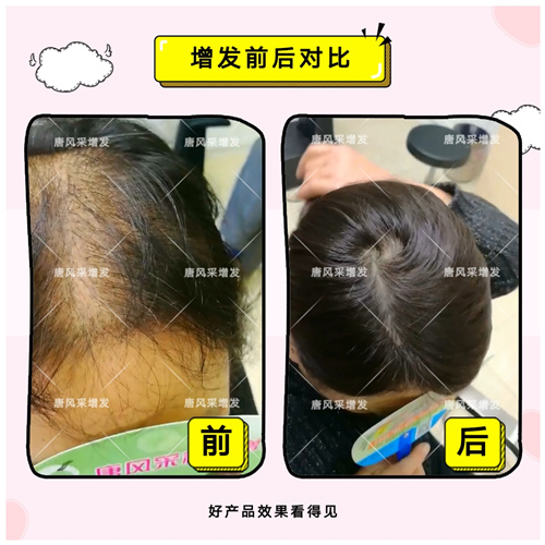 掉頭發(fā)和脫發(fā)，你分清楚了嗎？ 