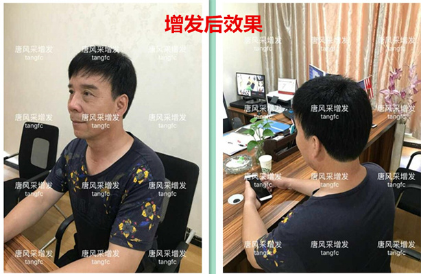 如何生發(fā)密發(fā)?到底有沒(méi)有生發(fā)奇效的藥物呢？