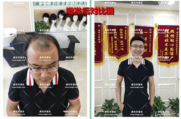 他被脫發(fā)“啃老”是與遺傳有關(guān)啊！