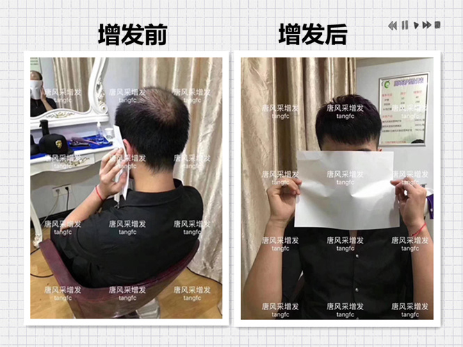 防偷防盜防不了發(fā)際線, 變禿頂了怎么辦？