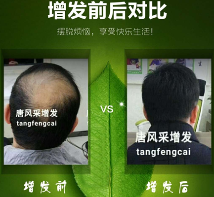 脫發(fā)嚴(yán)重咋辦？