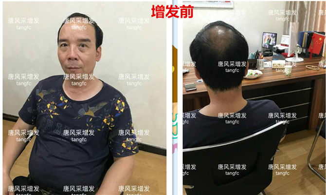 朋友碰面不敢認(rèn)，直擊發(fā)友增發(fā)后的真實(shí)改變！