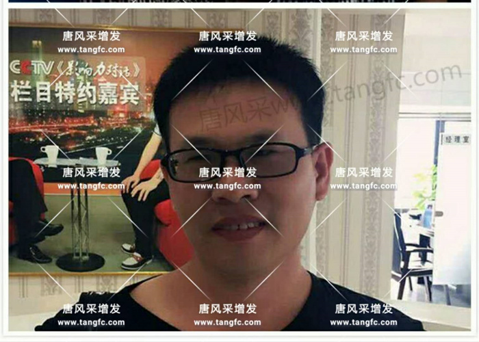 老師，我要你“脫”掉禿頂！