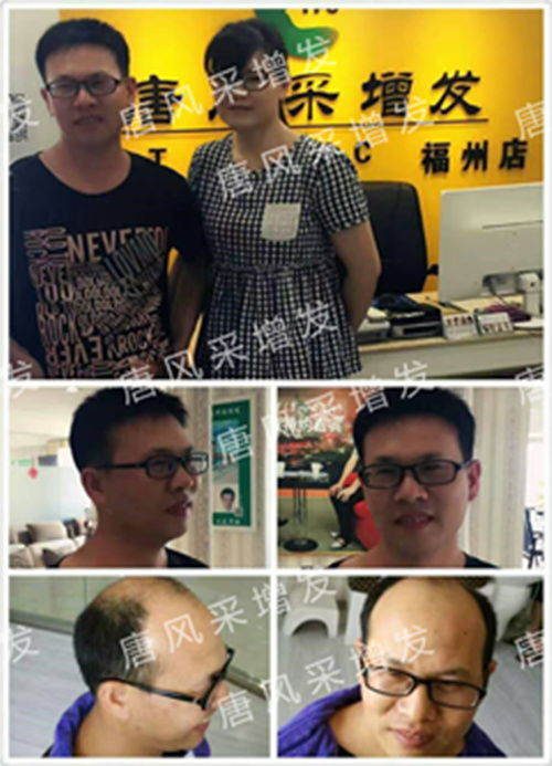 老師，我要你“脫”掉禿頂！