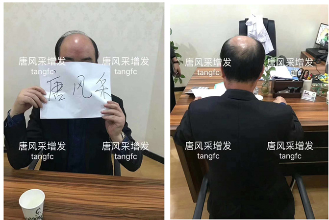 唐風(fēng)采假發(fā)案例 ，脫發(fā)謝頂后
