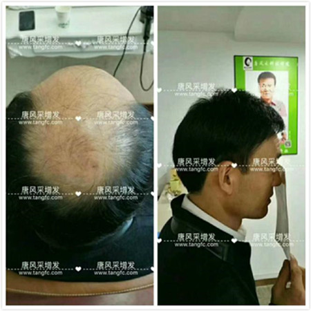 老年人白發(fā)變黑發(fā) 唐風采假發(fā)客戶