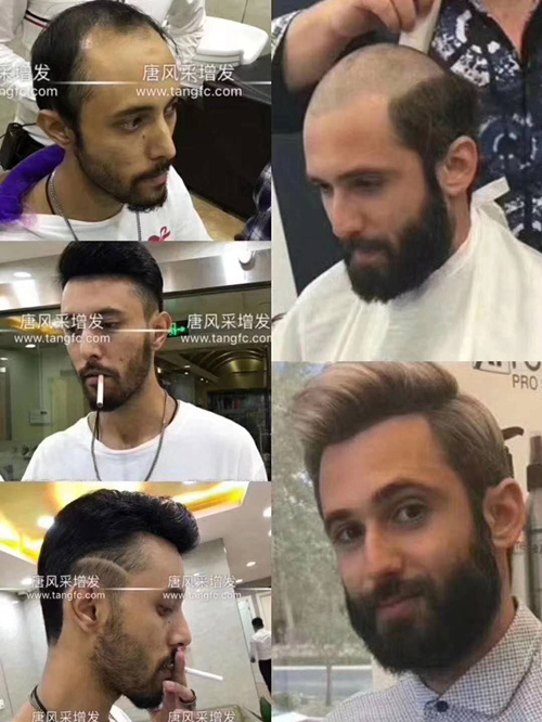 整容有風(fēng)險(xiǎn)愛美需謹(jǐn)慎 脫發(fā)顯現(xiàn)