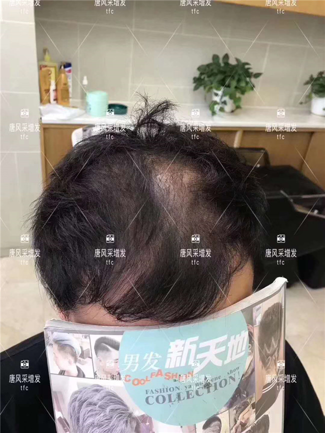 謝頂男人 在唐風(fēng)采假發(fā)后