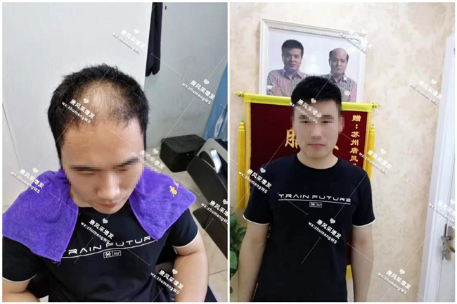 手工制作假發(fā) 脂溢性脫發(fā)的顧先生手工制作假發(fā)